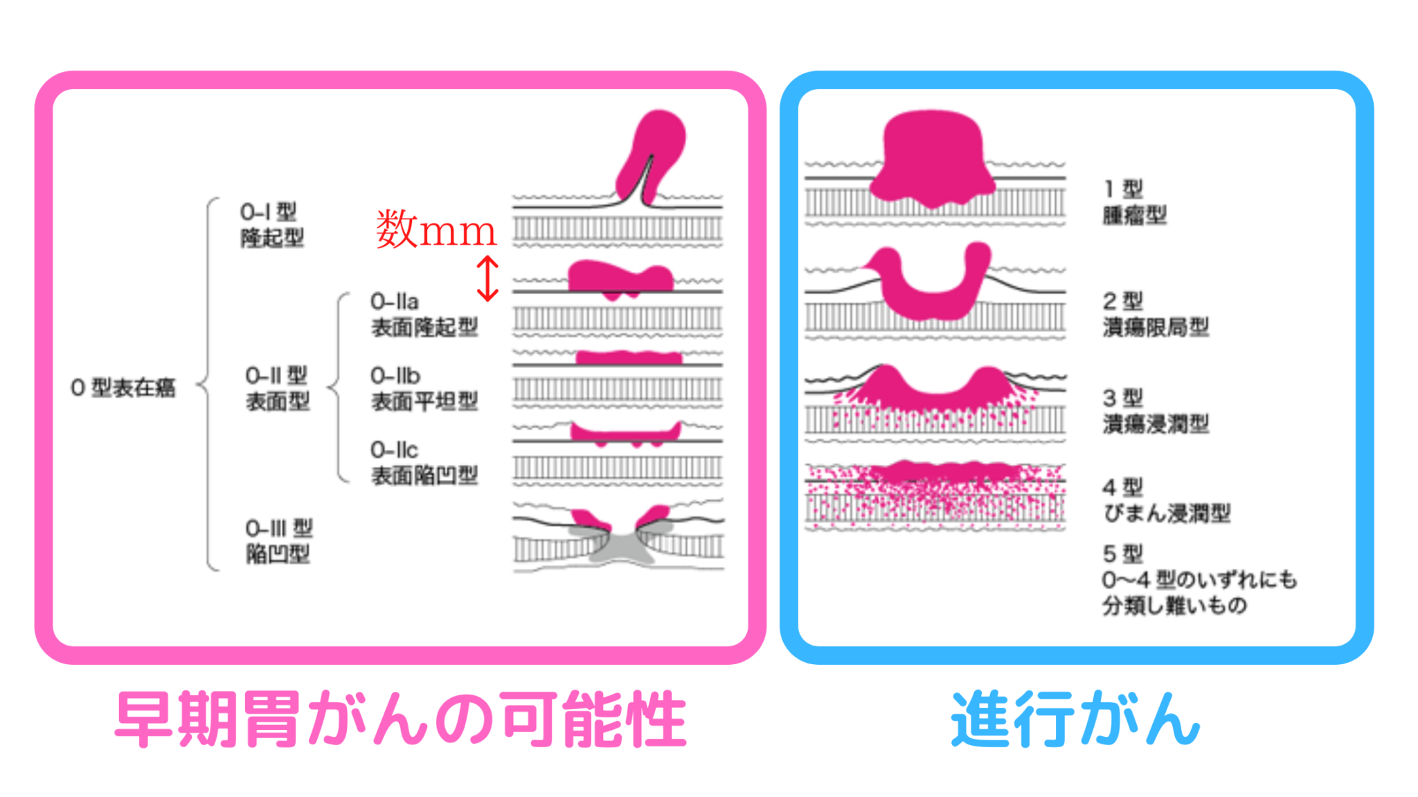 胃がん検診で失敗しないために注意すべき3つのポイント | 名古屋市中川区山王|水野クリニック